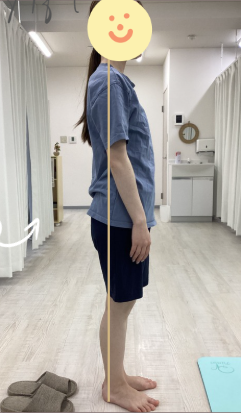 After 姿勢改善後